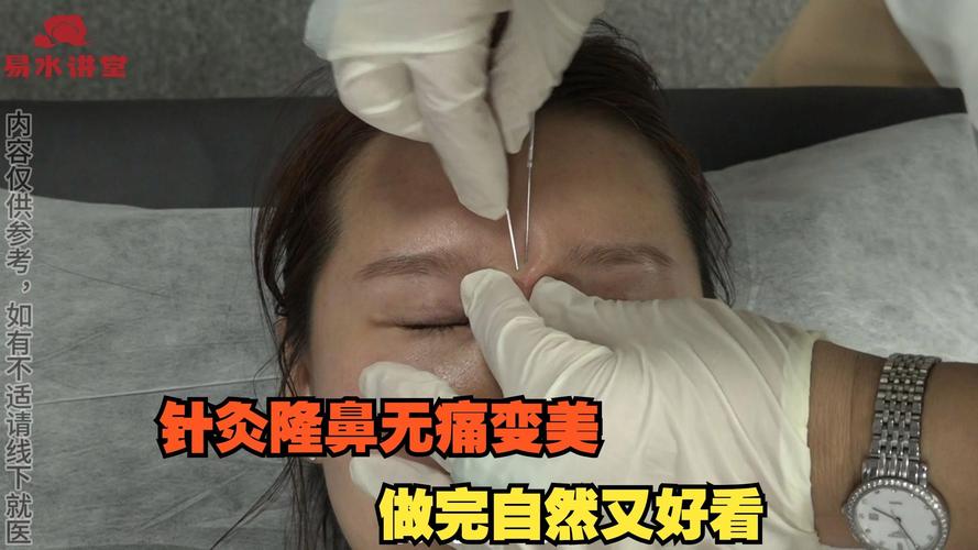 针灸隆鼻的效果好不好