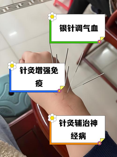 针灸可以隔着衣服扎吗