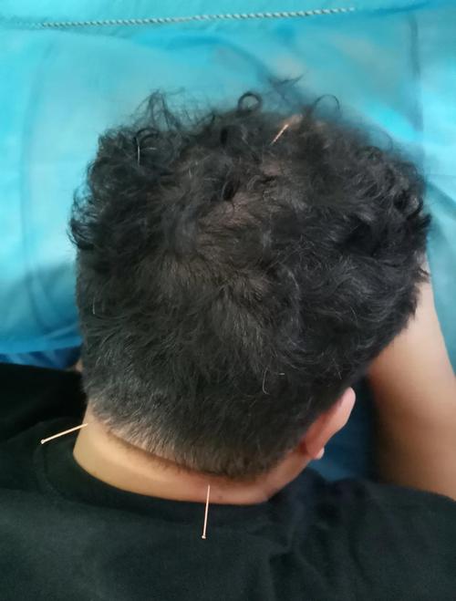 过敏性鼻炎针灸能好吗