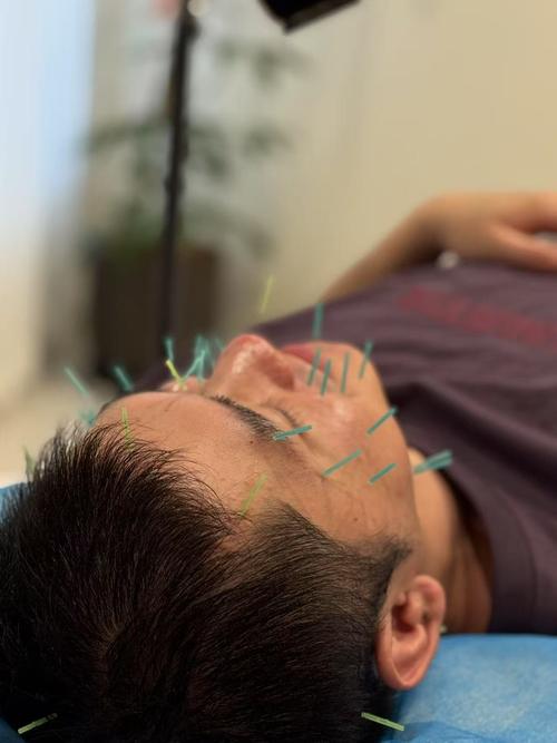 面神经麻痹针灸扎那侧