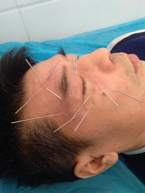 面神经麻痹针灸扎那侧