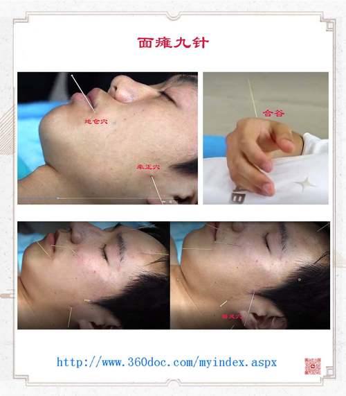 面神经麻痹针灸扎那侧
