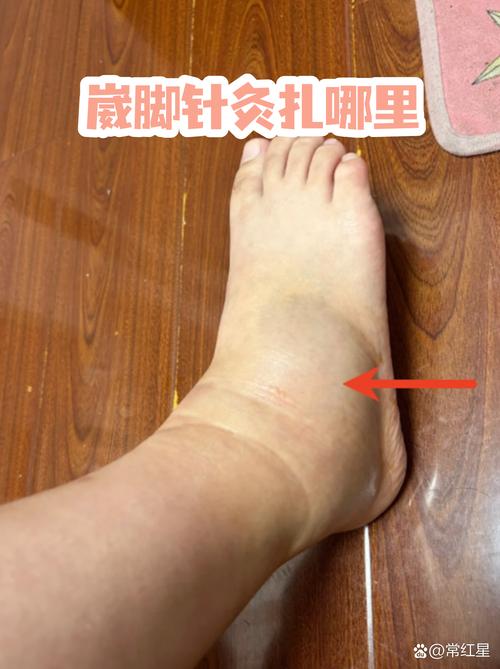 踝关节扭伤针灸示意图