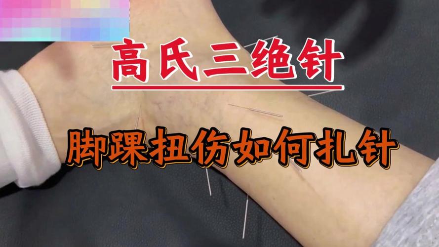 踝关节扭伤针灸示意图