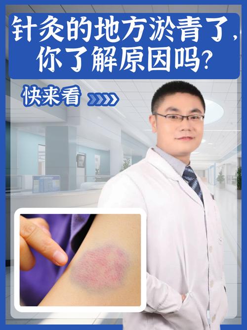 针灸脸部肿了怎么回事