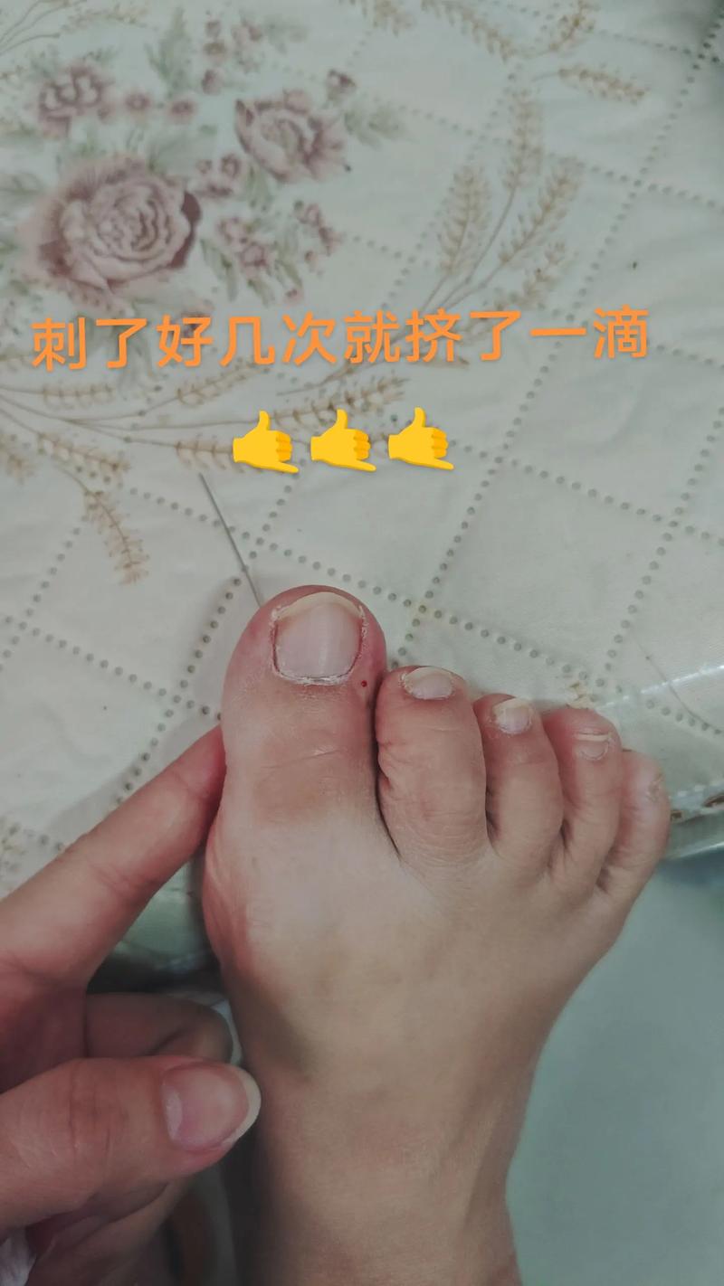 脚痛风自己放血放哪里