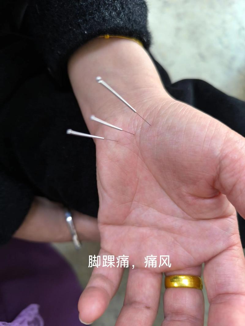 脚痛风自己放血放哪里