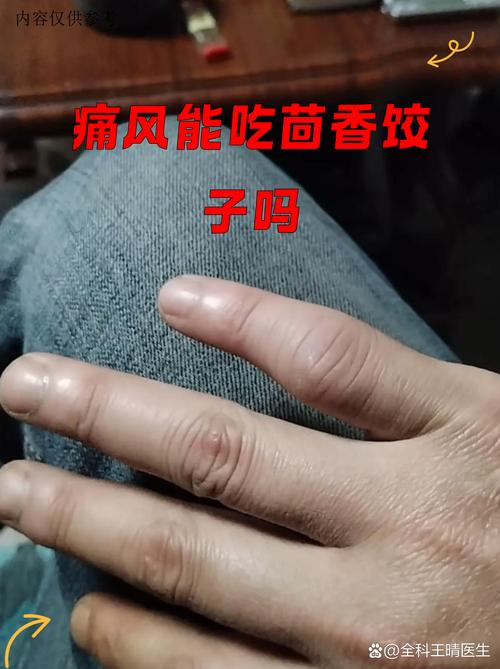 痛风茴香饺子可以吃吗