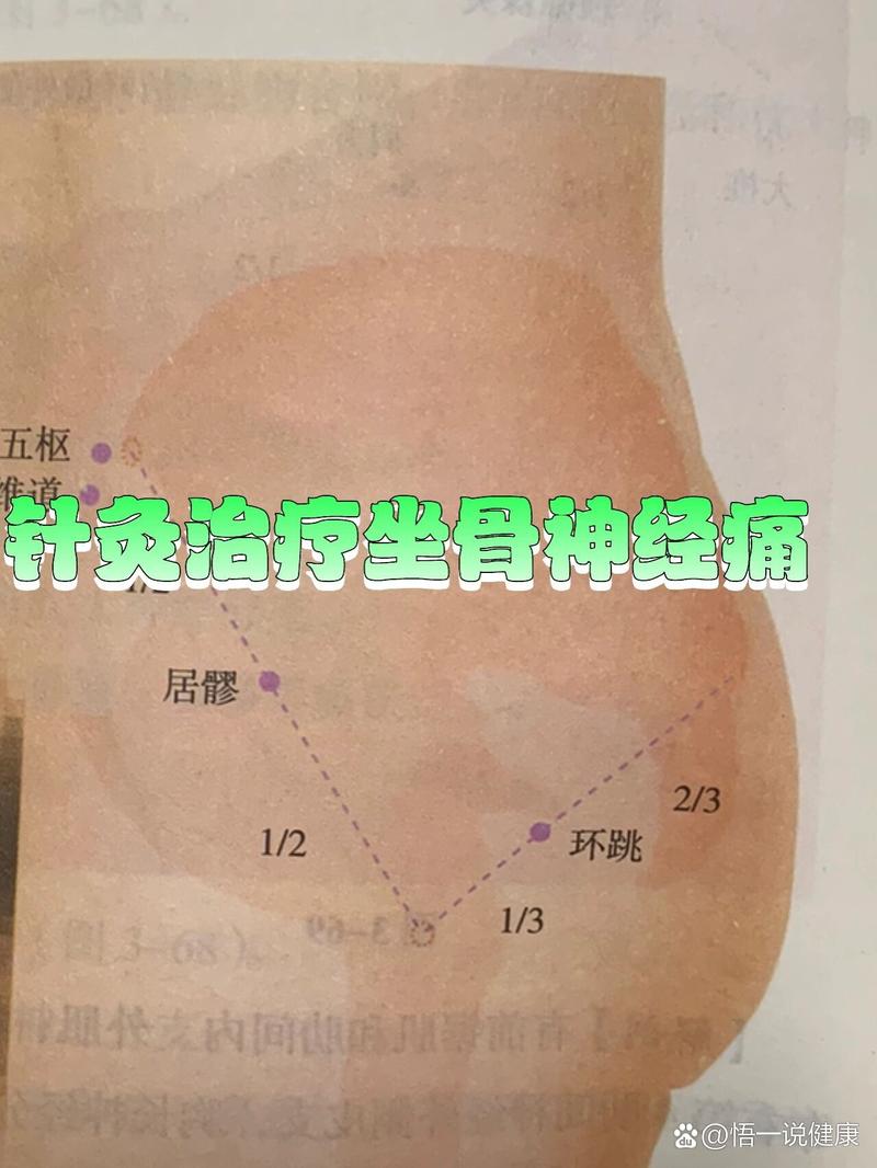 针灸坐骨神经有危险吗