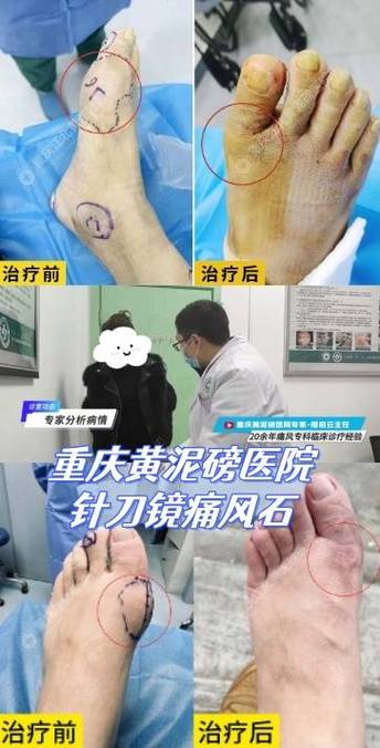 治疗痛风重庆九五舒适