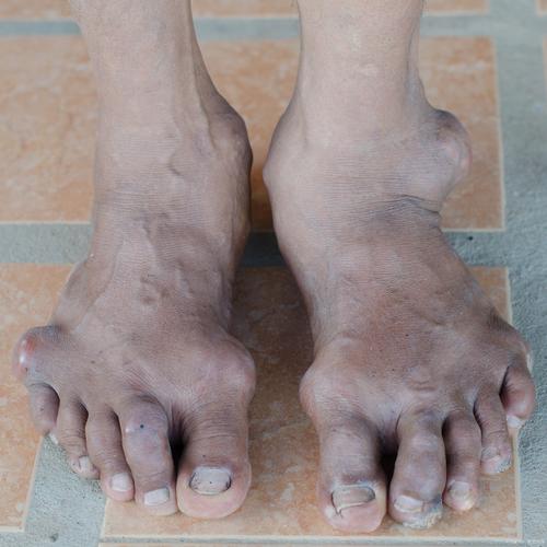 治疗痛风重庆九五舒适