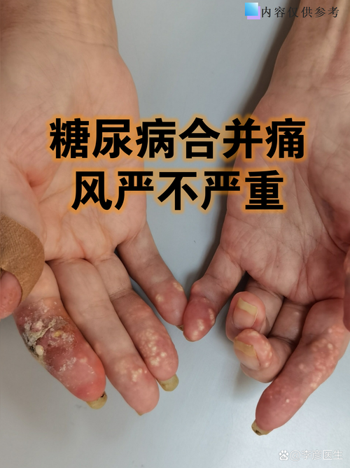 尿酸700多没有痛风