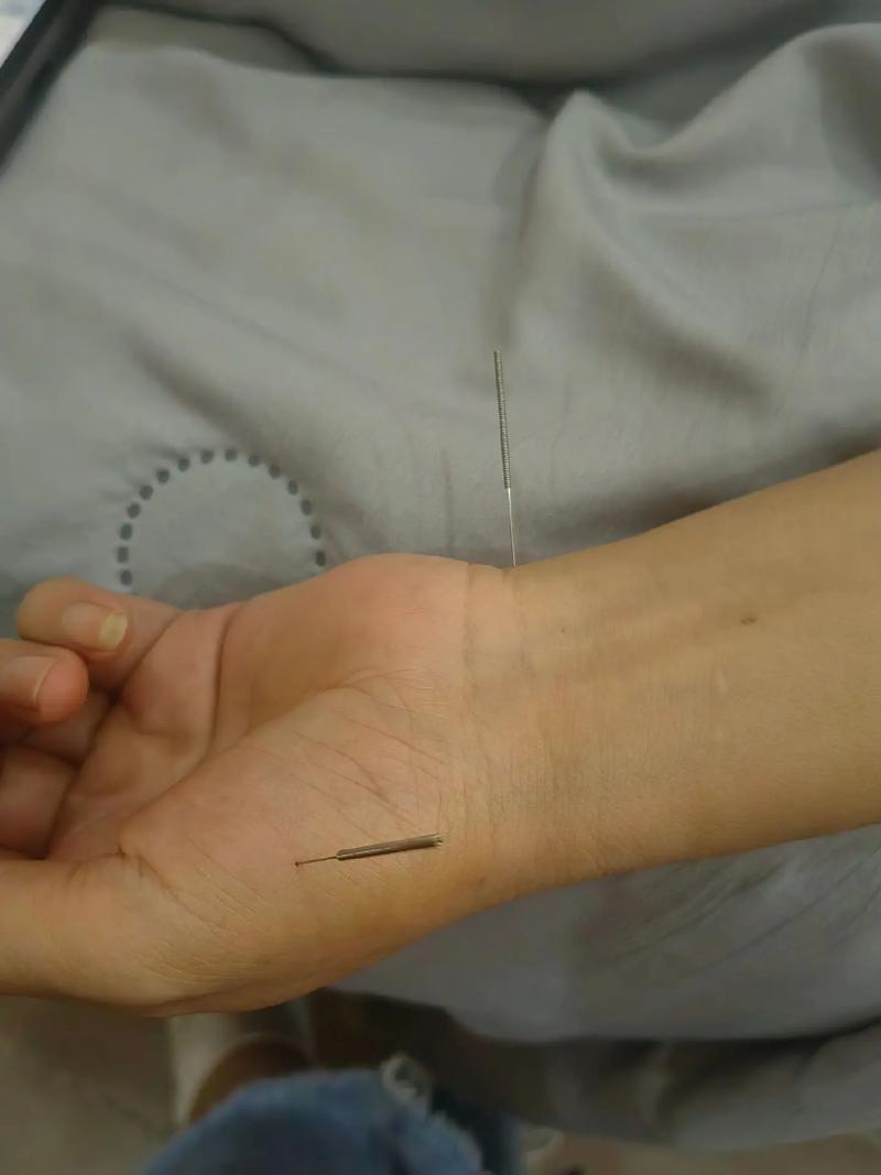 呃逆针灸治疗一针疗法