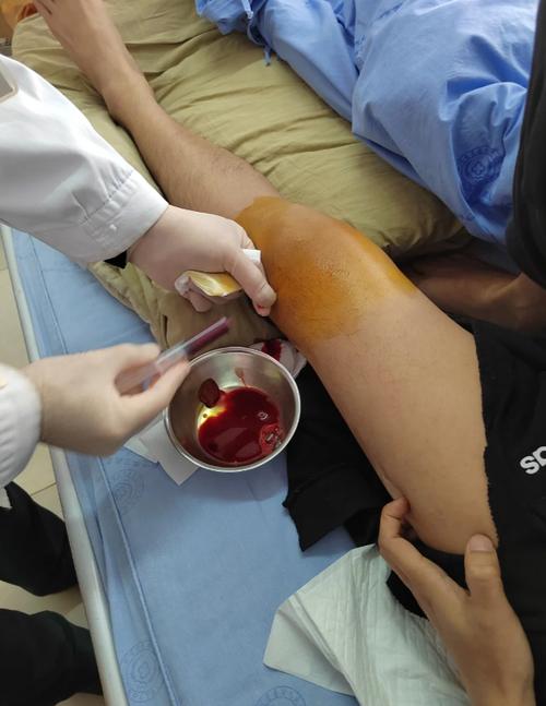 膝关节积液可以针灸吗