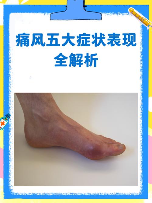 得了痛风会有什么症状