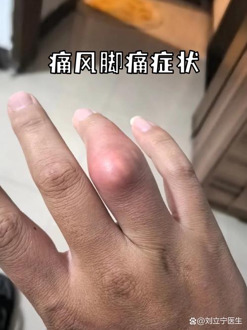 得了痛风会有什么症状