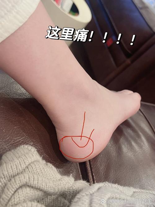 早上 脚后跟疼 痛风