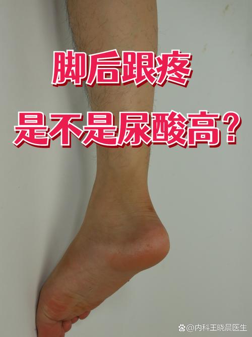 早上 脚后跟疼 痛风