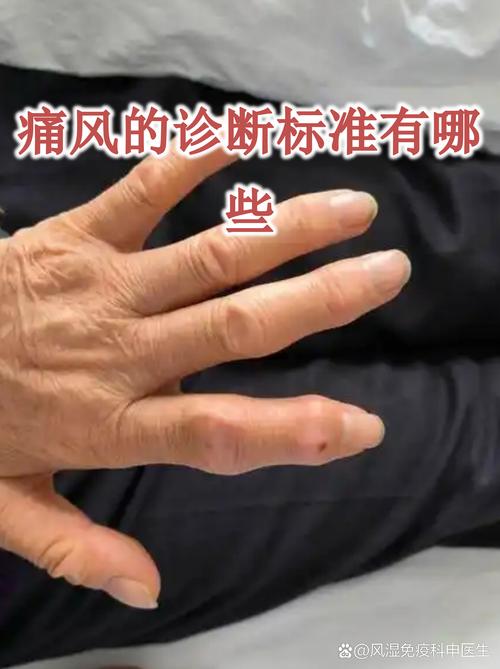 2026痛风诊断标准