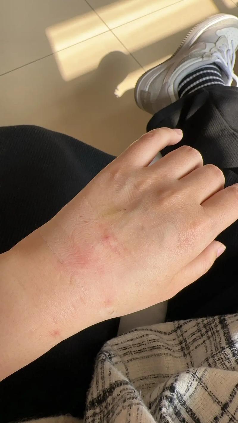 针灸后手肿了怎么回事