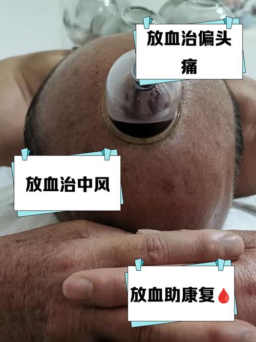 脑出血针灸的最佳时期