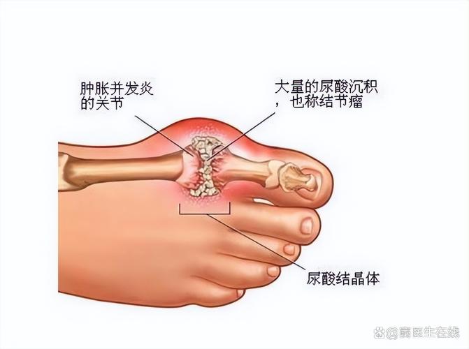 痛风是在脚的哪个位置