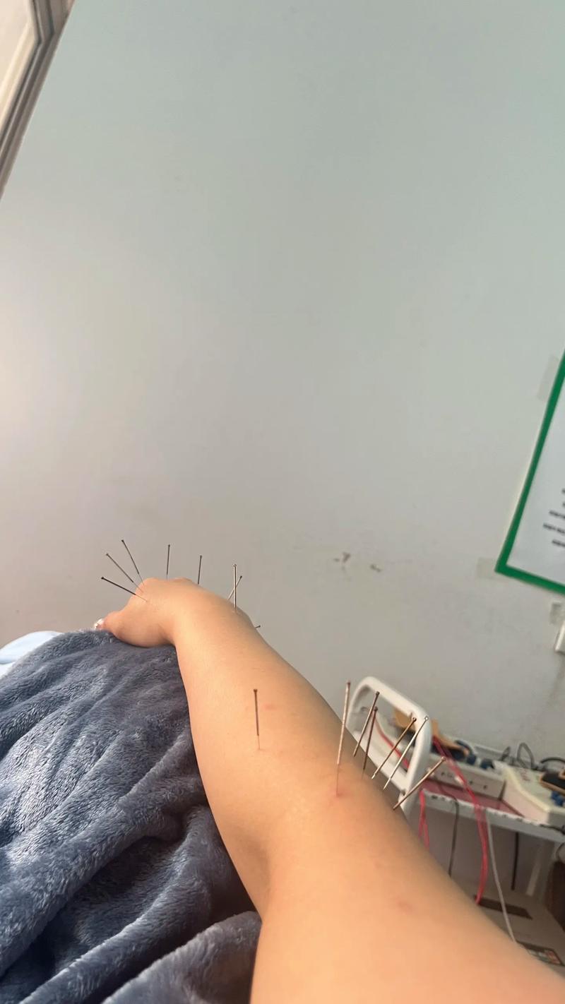 针灸后针眼痒怎么回事