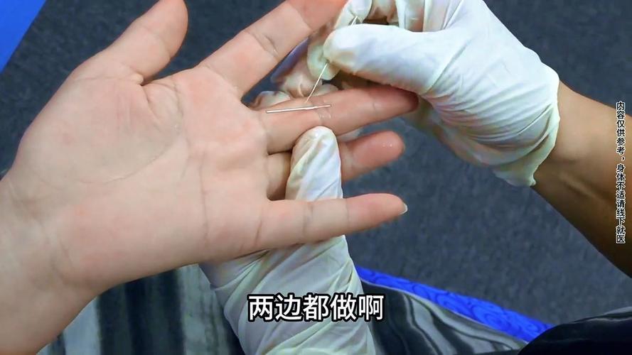 乳腺纤维瘤针灸管用吗