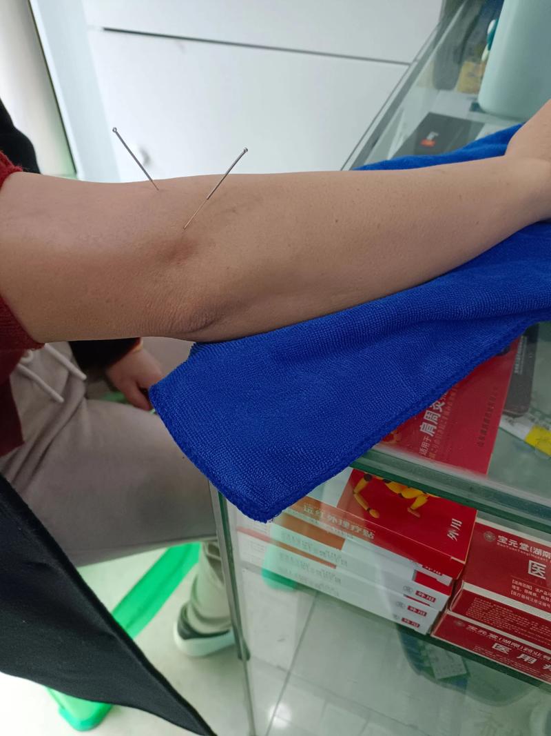 针灸治痔疮效果怎么样