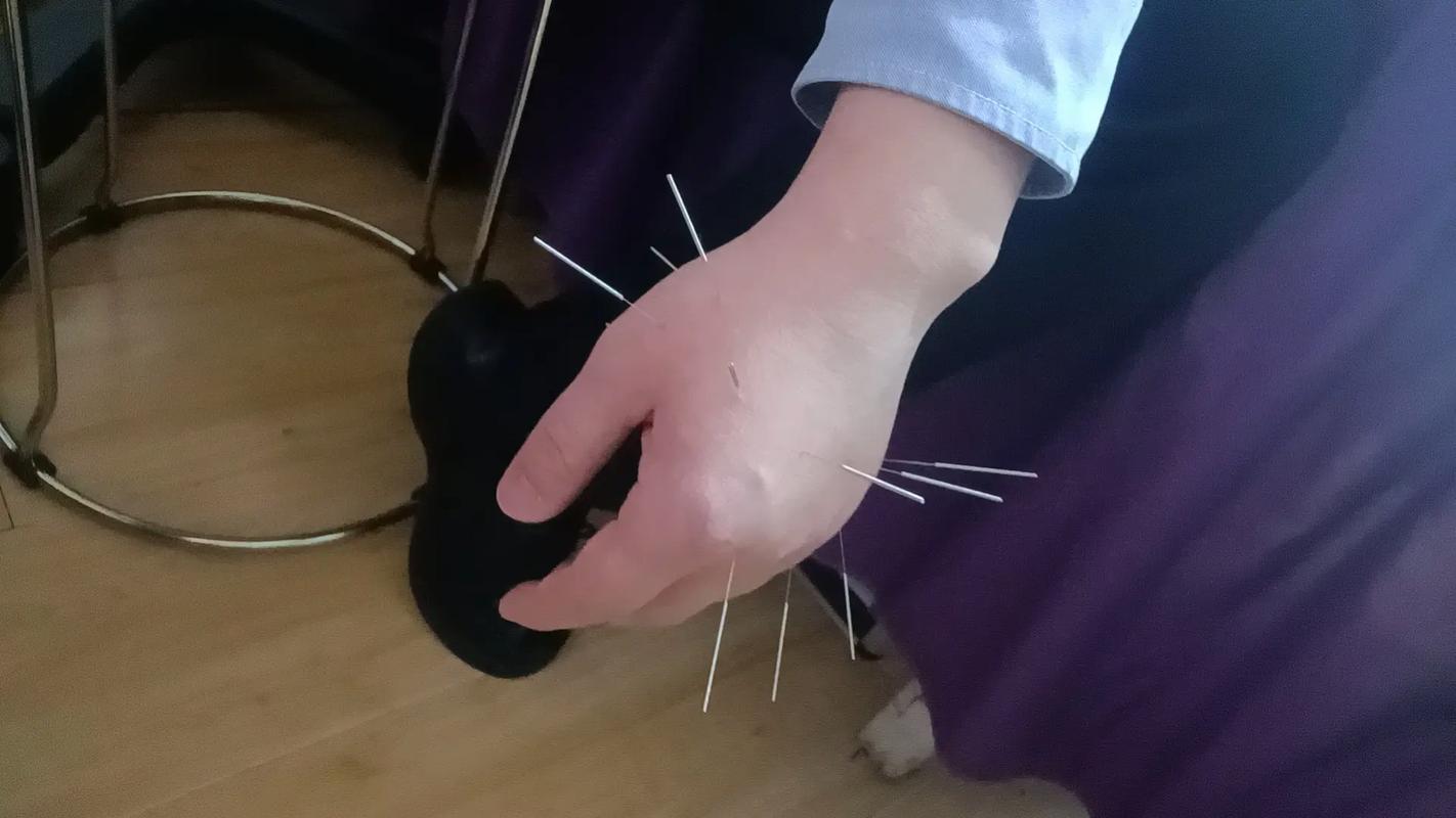 针灸治痔疮效果怎么样