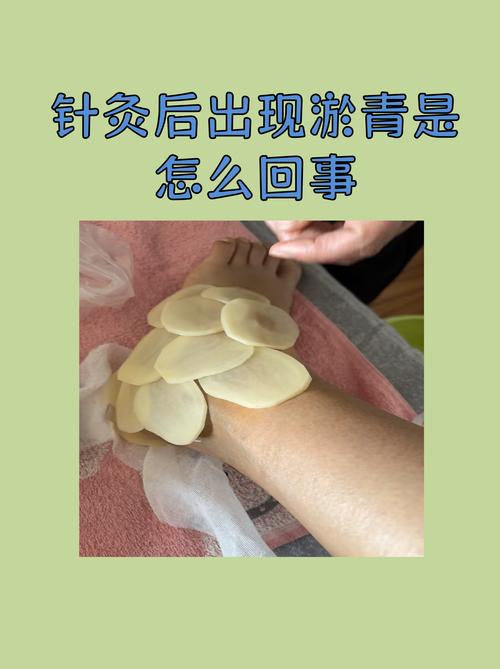 针灸后出水是什么原因