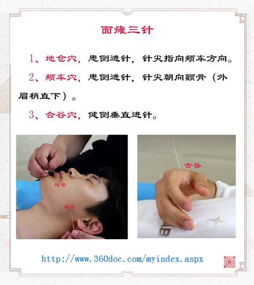 针灸面瘫一般多久会好