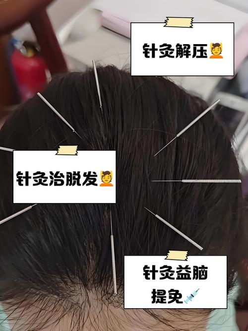 头部扎针灸的注意事项
