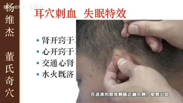 董氏针灸治失眠特效针