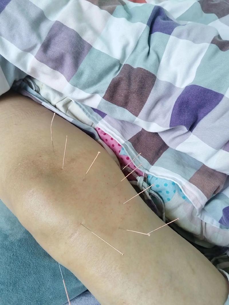 针灸后腿酸是什么原因