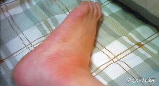 高血压与痛风哪个严重