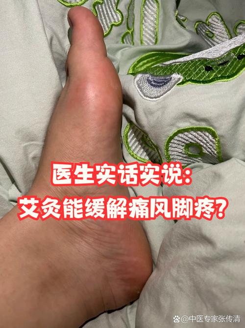 艾灸治疗痛风 单桂敏