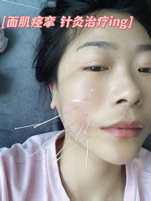面肌痉挛针灸效果好吗