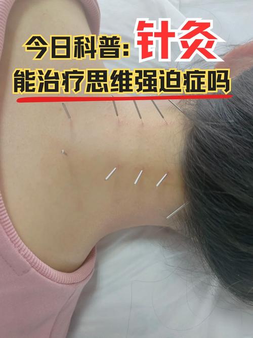 针灸治疗脑梗效果好吗