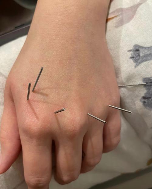 为什么面瘫针灸要扎手