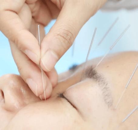 中医针灸能治真性近视