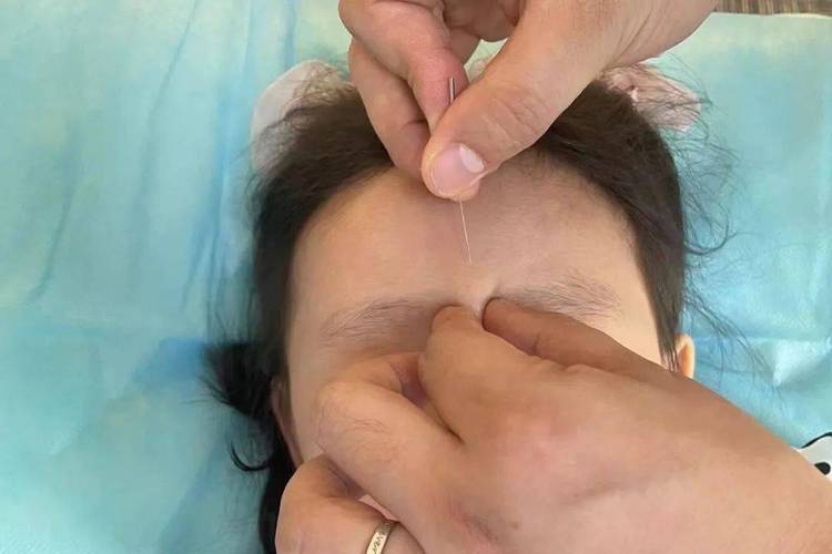 中医针灸能治真性近视