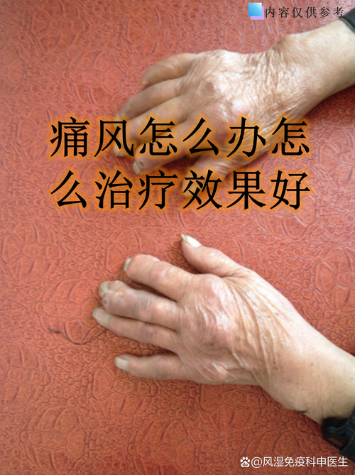 上海那家医院治痛风好