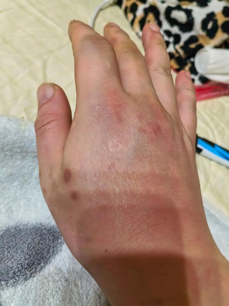 痛风肿了怎么快速消肿