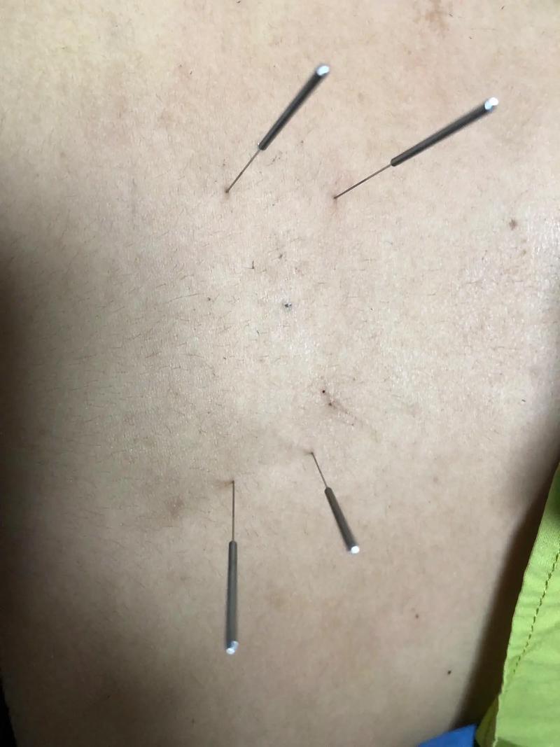 腰椎突出针灸有效果吗