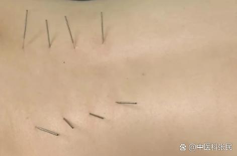 腰椎突出针灸有效果吗