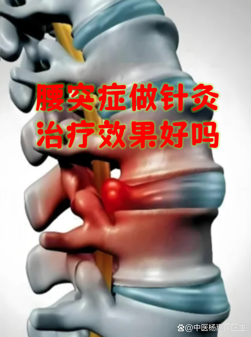 腰椎突出针灸有效果吗