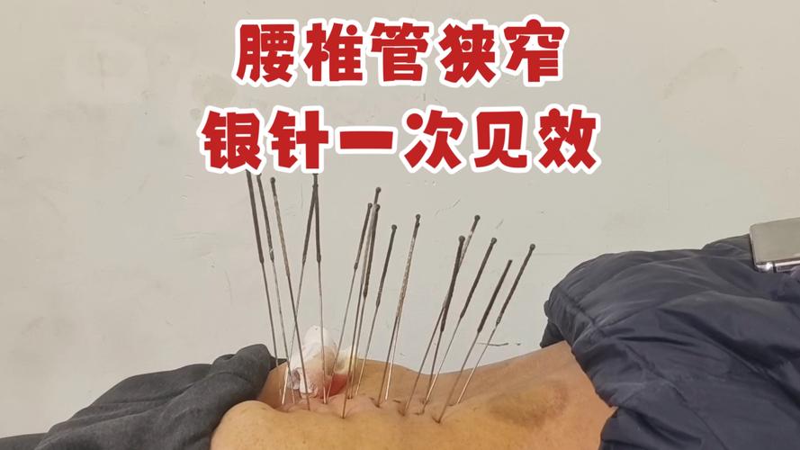 椎管狭窄针灸能治好吗