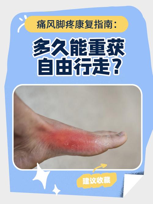 痛风右脚好了左脚就痛