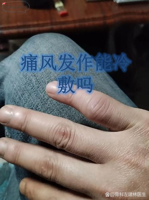 痛风可以热敷或冷敷吗